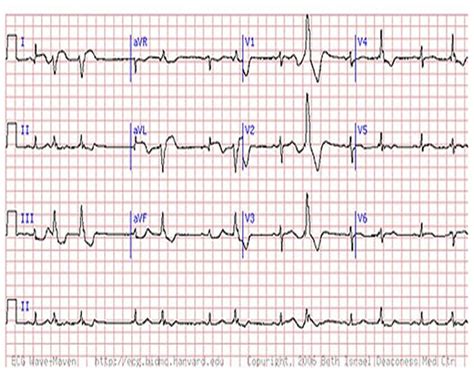 Are You Missing Subtle Mi Clues On Ecgs Test Your Skills