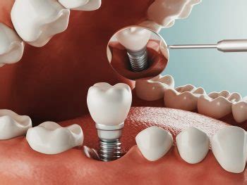 Dental Implant Side Effects Archives The Dental Implant Place