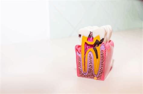 Root Decay: What Is and How to Treat It? - Teeth Wisdom