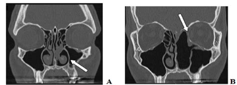 Second Patient A Pre Surgery Maxillofacial Ct Bilateralipertrophic