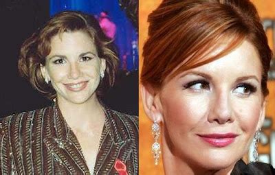 Melissa Gilbert Plastic Surgery