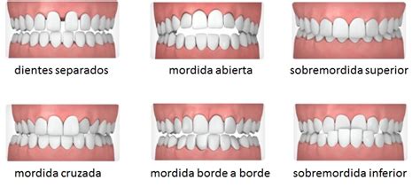 ¿qué Es La Maloclusión Dental Belén Pérez Dental