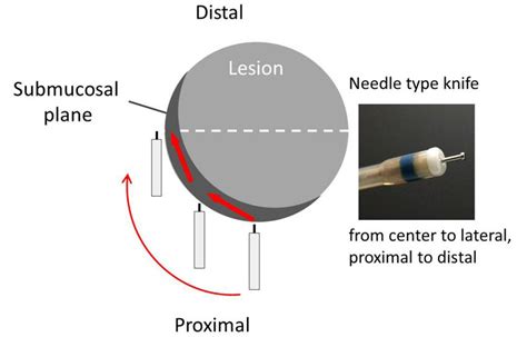 Procedure For Submucosal Dissection With A Needle Type Knife Download Scientific Diagram