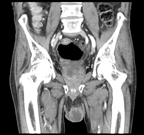 Scrotal Abscess Image