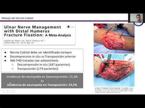 Fractura H Mero Distal Osteos Ntesis Con Placa Youtube