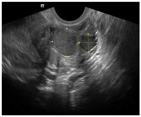 Transvaginal Ultrasound in the Diagnosis and Assessment of