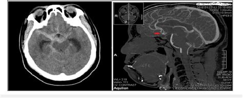 Figure 1 From A Review Of Aneurysmal Subarachnoid Hemorrhage Managed In Abuja North Central