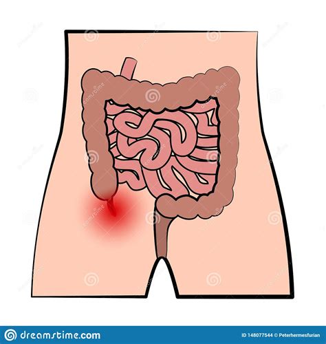Annexe Enflamm E Appareil Digestif D Appendicite Illustration De