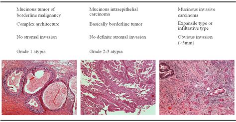 Clear Cell Adenocarcinoma Ovary