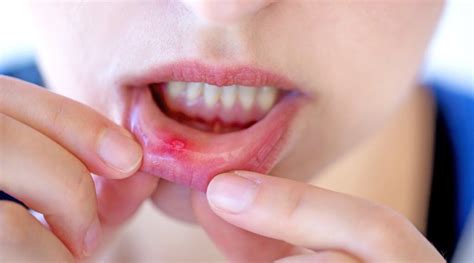 Canker Sore Vs Cancer How To Know