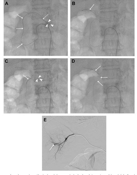 Figure 2 From Microcatheter Looping Technique For Catheterization Of The Proper Hepatic Artery