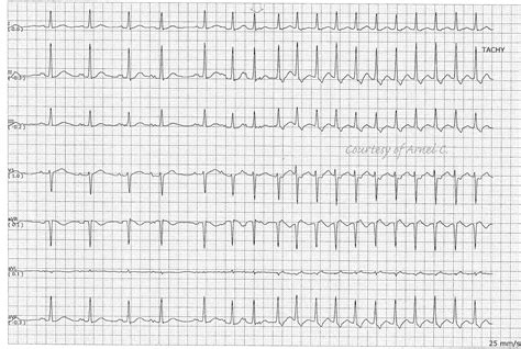 ECG Rhythms: Atrial Arrhythmia Triggering AVNRT