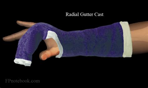 Radial Gutter Cast