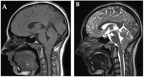 Brain Sciences Free Full Text Decoding Chiari Malformation And Syringomyelia From