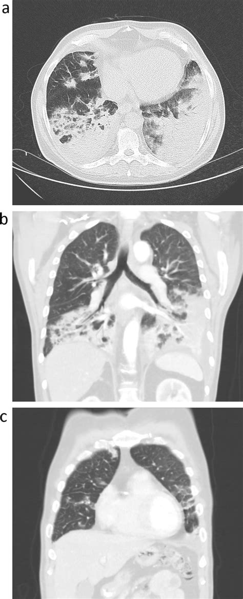 High Resolution Computed Tomography Images A Computed Tomography Axial Download Scientific