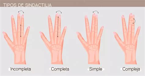 Sindactilia En Qu Consiste La Malformaci N De Almudena Cid