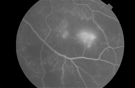 The ocular complication shown here has been associated with what condition? | Duke Health ...