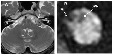 Cerebellopontine Angle Cpa Tumor In A Year Old Patient With Left