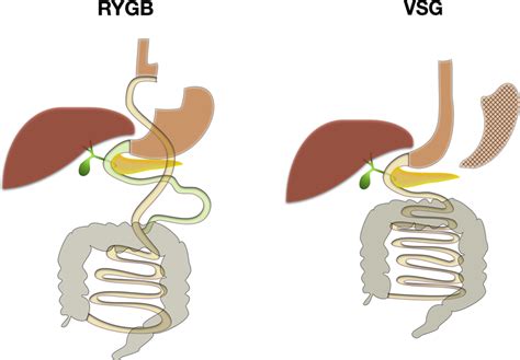 Rygb And Vsg Weight Loss Procedures Schematic Of Roux En Y Gastric