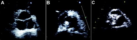 Early Surgery Versus Conventional Treatment In Asymptomatic Very Severe