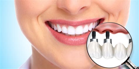 İmplant Nedir DENTOLYA I Özel Ağız ve Diş Sağlığı Merkezi