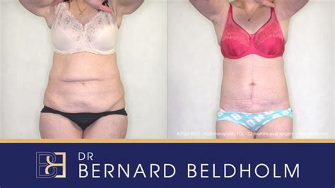 Fleur-de-Lis Abdominoplasty Post Weight Loss Before & After Results