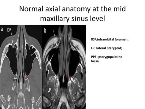 Carcinoma Maxillary Sinus Ppt