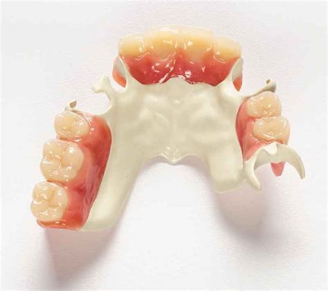 removable partial denture for one tooth - rollieroegner-99