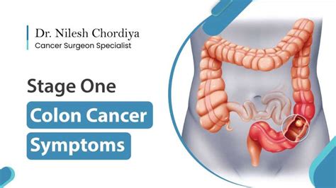 Stage One Colon Cancer Symptoms | Dr. Nilesh Chordiya