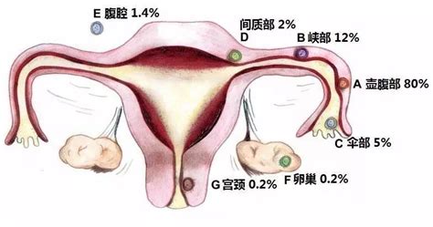 子宮脫垂懸吊術手術名稱別名分類編碼概述適應症禁忌症術前準備麻醉和中文百科全書