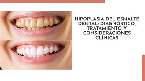 Hipoplasia Del Esmalte Dental Apuntes Salud Dental Udocz