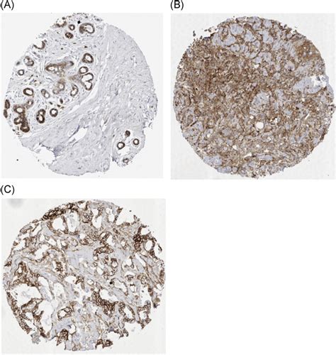 A Shift From Membranous And Stromal Syndecan1 CD138 Expression To