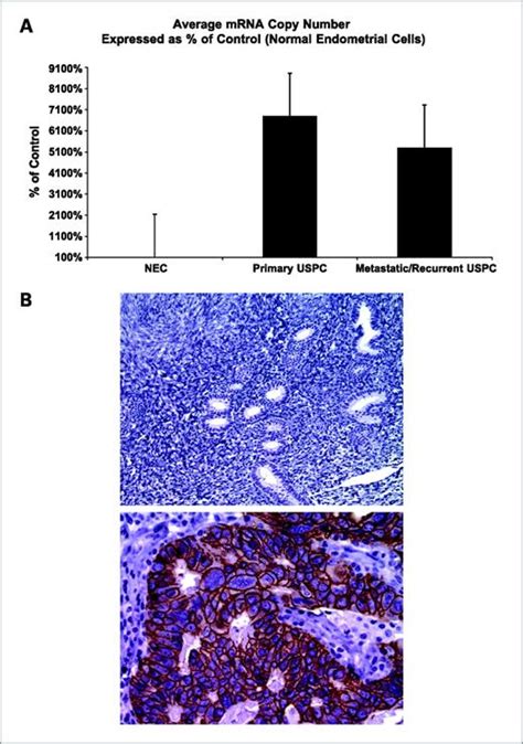 Overexpression Of Epcam In Uterine Serous Papillary Carcinoma