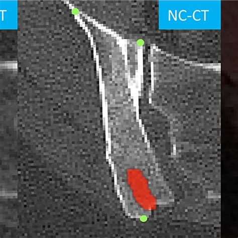 Right Posterior Iliac Blade Metastasis In A 67 Year Old Lymphoma Download Scientific Diagram