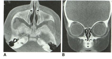 Figure 1 from Congenital nasal piriform aperture stenosis. | Semantic ...