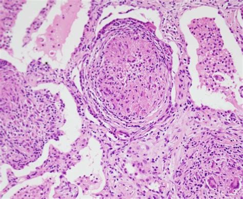 Sarcoidosis Histology