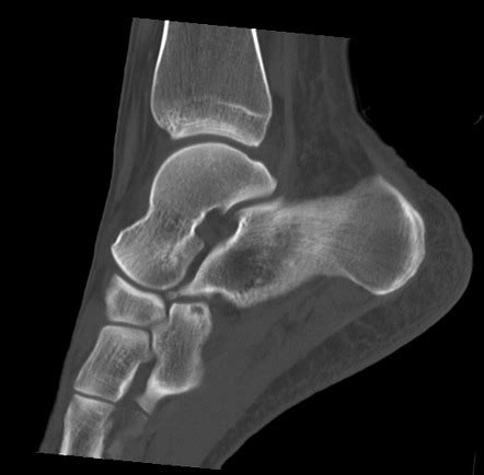 Talar Dome Osteochondral Injury Image Radiopaedia Org