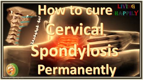 How To Cure Cervical Spondylosis Permanently Neck Pain Living