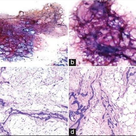 Pdf Lipomatous Pleomorphic Adenoma In The Hard Palate Report Of A Rare Case With Cyto Histo