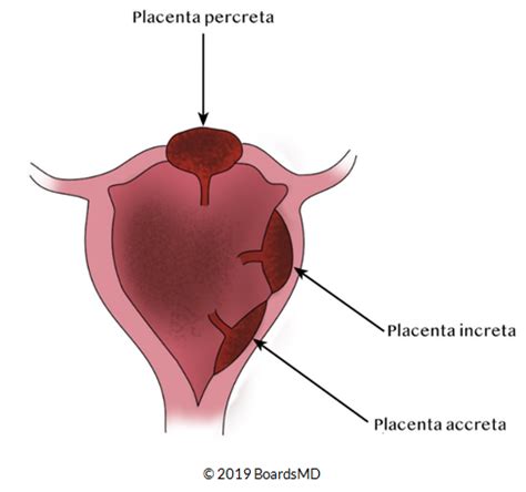 Postpartum Hemorrhage