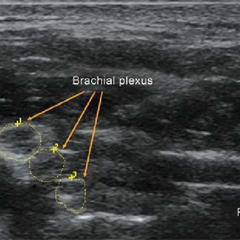 Pdf Ultrasound Guided Supraclavicular Brachial Plexus Block