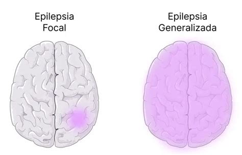 Convuls O E Epilepsia O Que Quais As Causas Cura E Tratamento