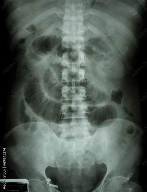 Foto De Small Intestine Obstruction Film X Ray Abdomen Supine Show