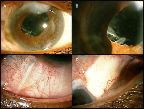 Post Operative Slit Lamp Photographs Showing A Superotemporal And