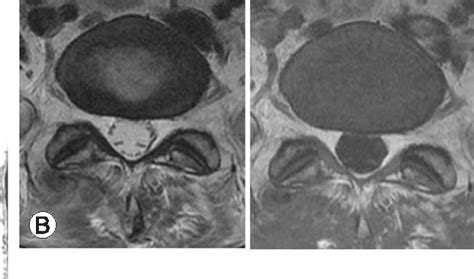 Figure 2 From Mri Changes Of The Spinal Subdural Space After Lumbar