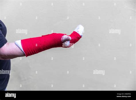 Broken Arm Bone In Cast Red Stock Photo Alamy