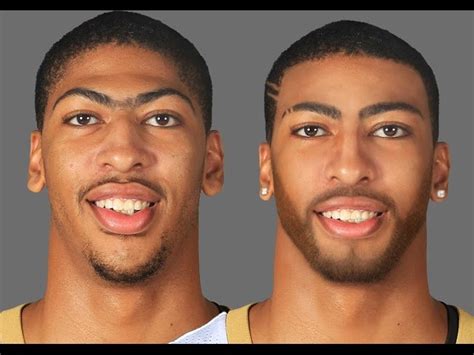 Anthony Davis Fix His Teeth