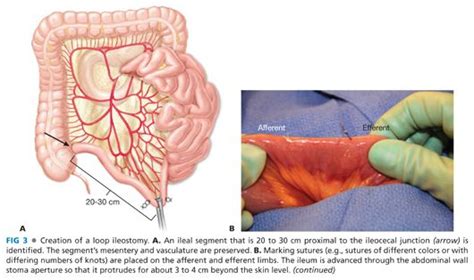 End And Diverting Loop Ileostomies Creation And Reversal Abdominal Key