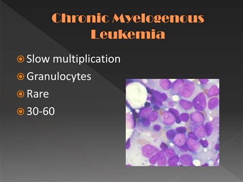 Ppt Leukemia Powerpoint Presentation Free Download Id 2057921