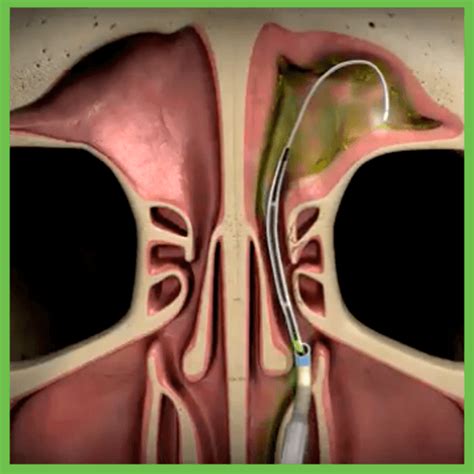 Is Balloon Sinuplasty A Good Option Houston Advanced Sinus